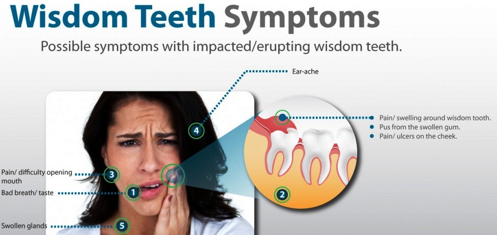 wisdom-tooth-symptoms-1024x566
