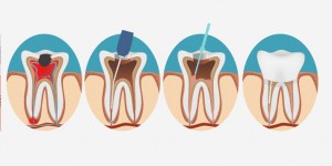 Root canal procedure.