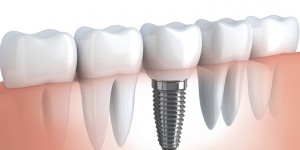 What are dental implants?