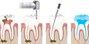 What is the root canal treatment?