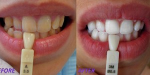 Possible side effects and contraindications for the teeth whitening