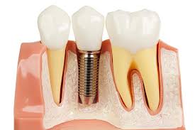 dental implant 1