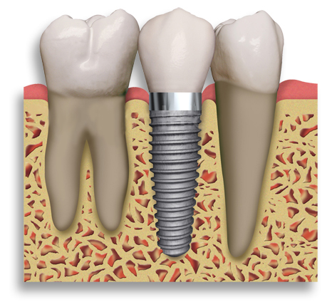 dental implant