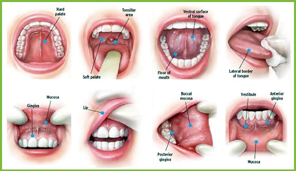 oral cancer