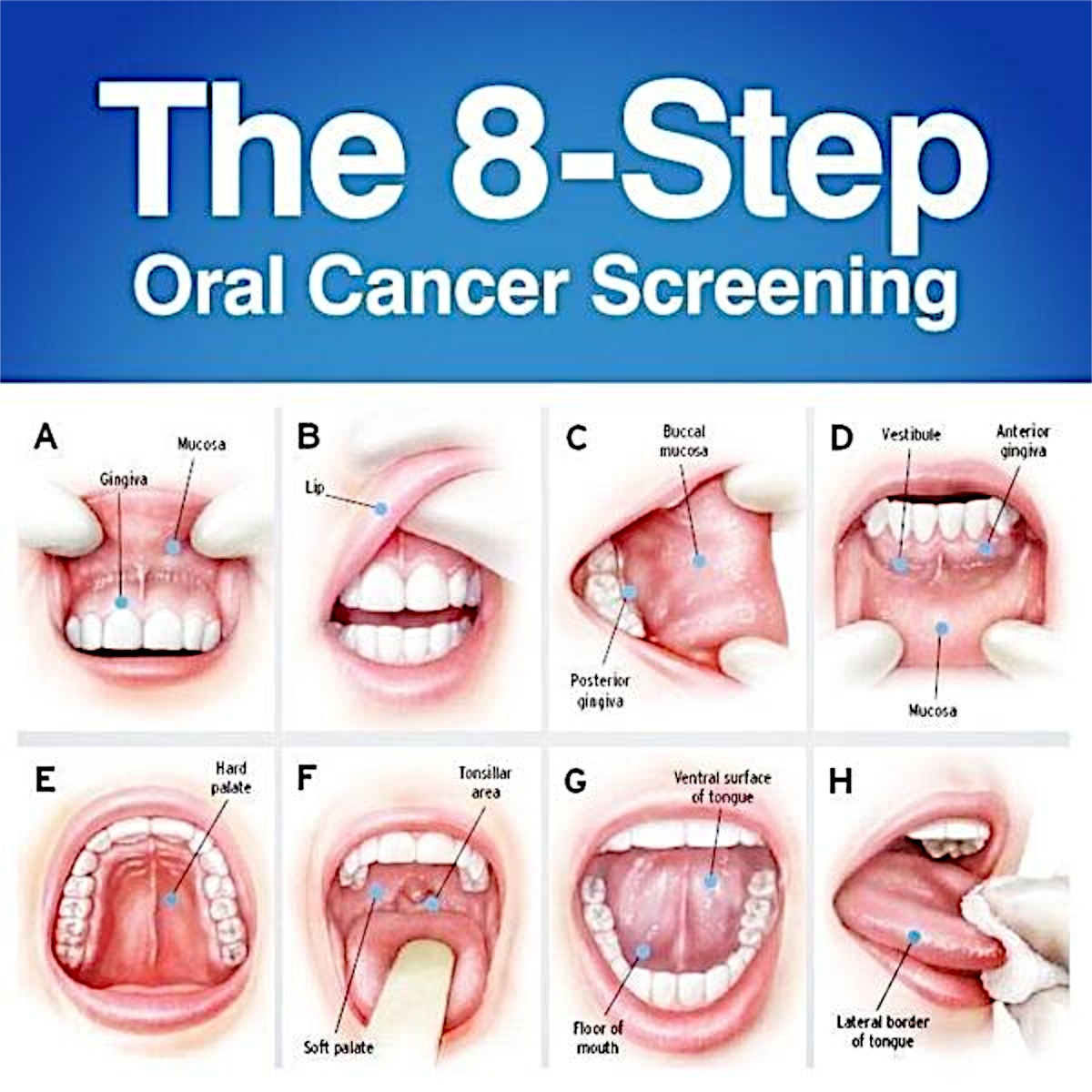 Floor Of Mouth Cancer