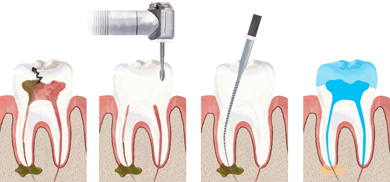 What is the root ca...