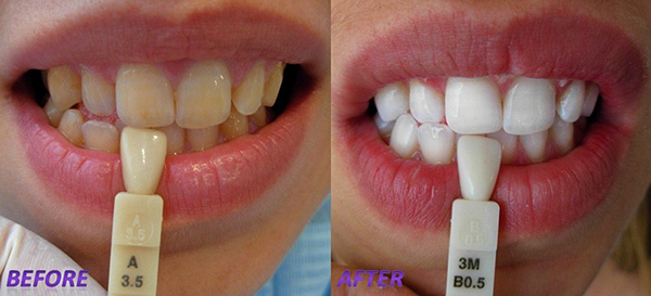 teeth whitening aspendale