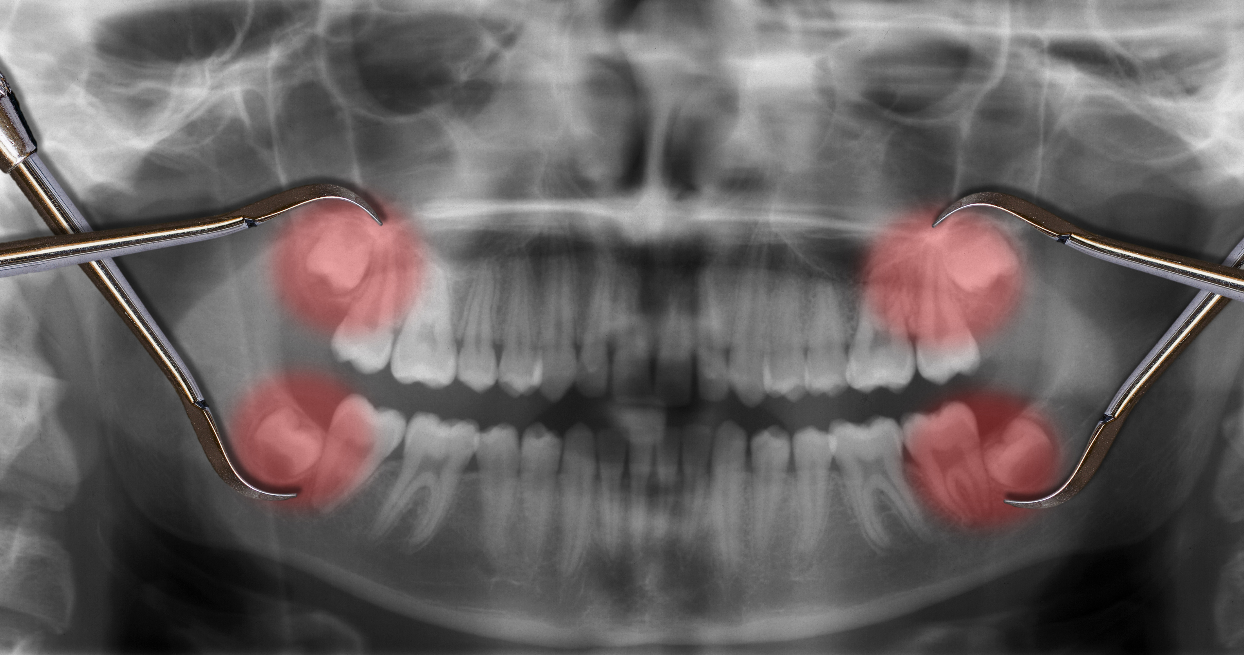 display four wisdom teeth over x-ray